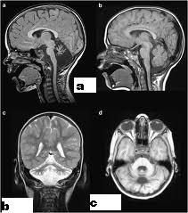 نتیجه تصویری برای ‫تصویرخونریزی  MRI‬‎